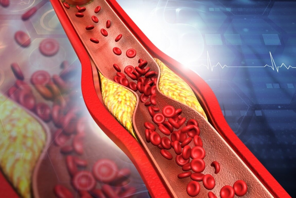 Colesterol HDL vs LDL: entenda a diferença! 